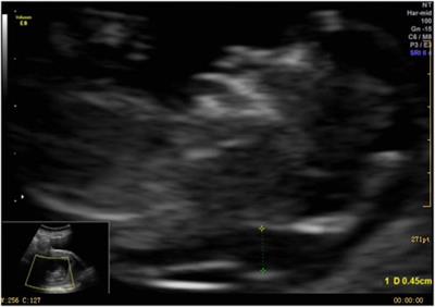 Case report: A case report and literature review of complete trisomy 9